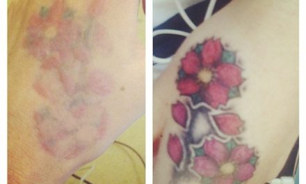 Tatuaggi – nuova denuncia contro Skinial – gravi lesioni alla pelle dopo la rimozione